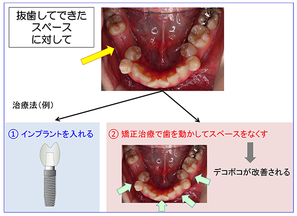 抜歯後治療2_600